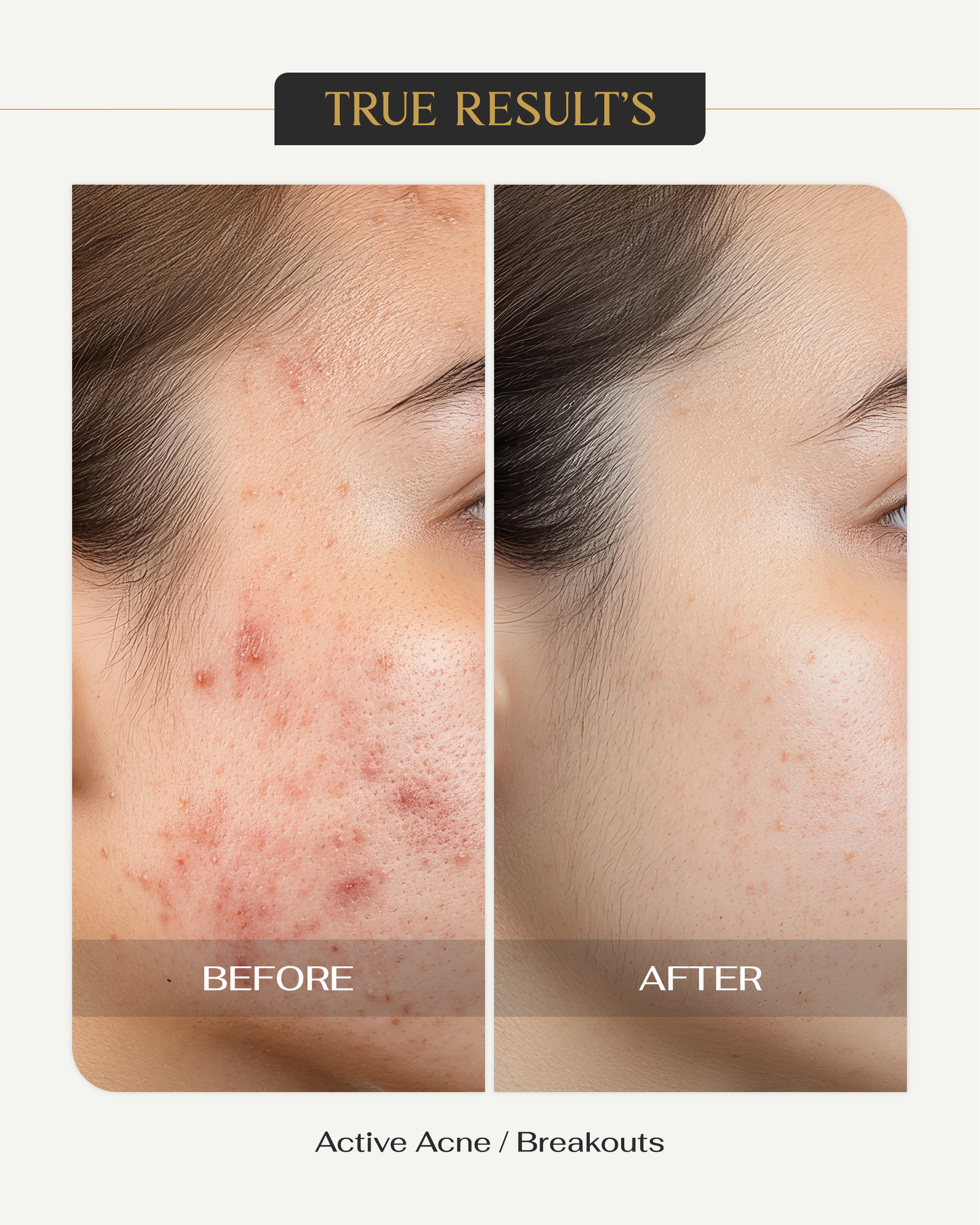 Acne Clear Face Serum